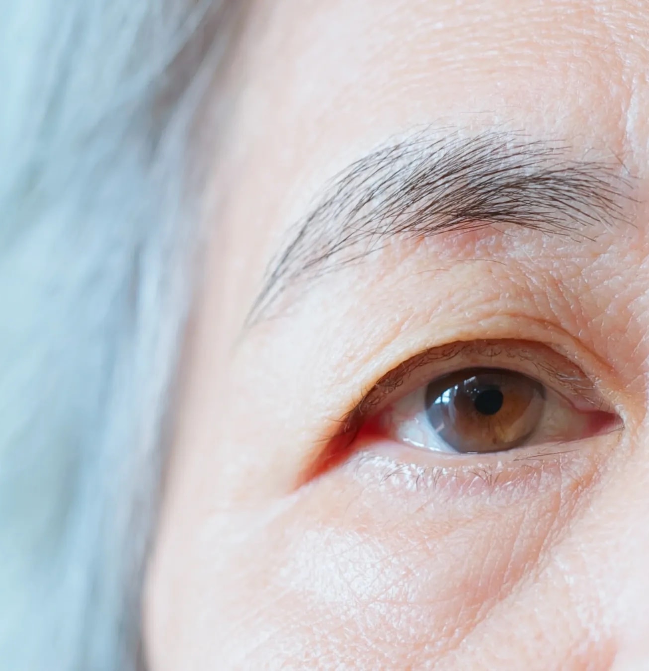 Upper Blepharoplasty